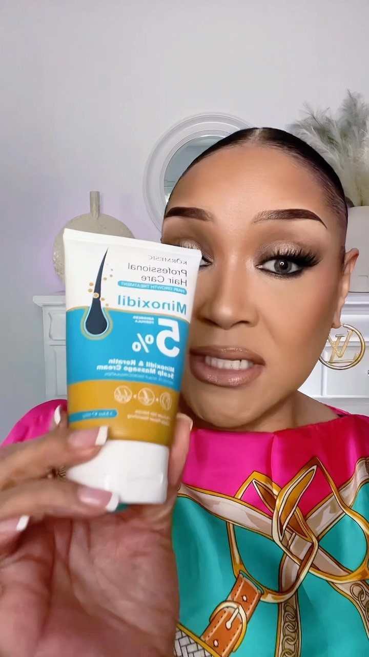 Woman holding a tube of Minoxidil 5% foam for hair regrowth treatment.