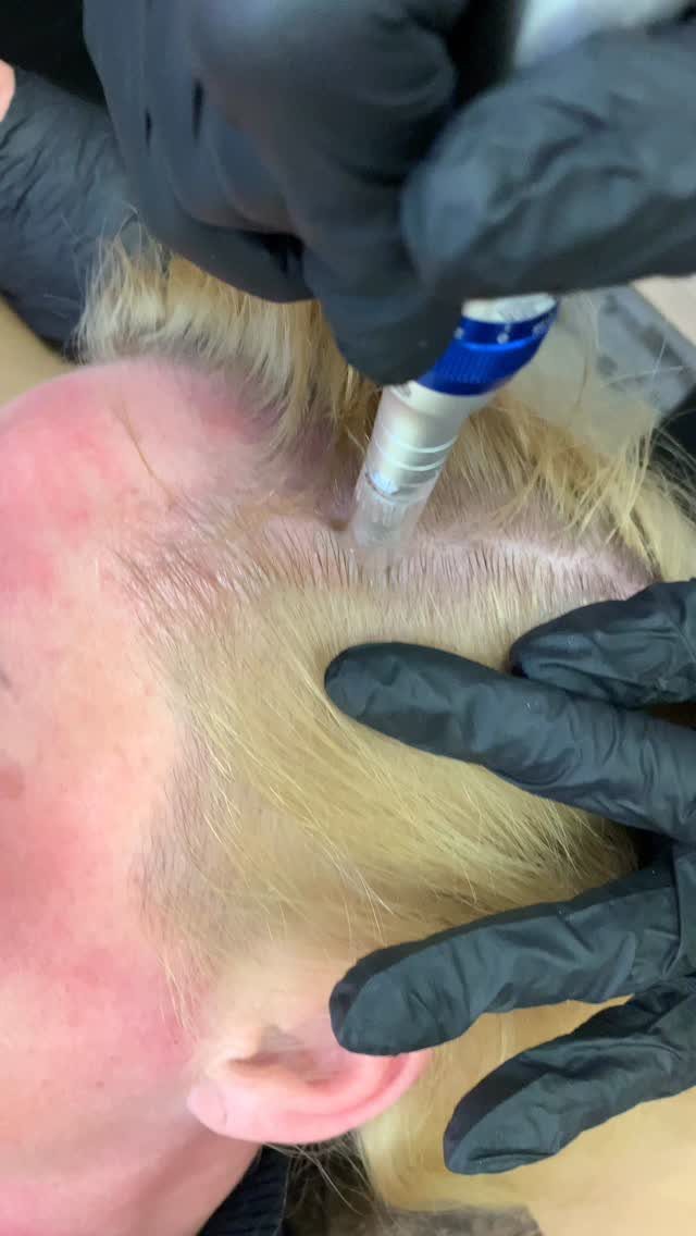 7 Ways to Make Hair Grow Faster, From Biotin to Microneedling 5 Microneedling device being applied to a person's scalp by gloved hands for hair growth.